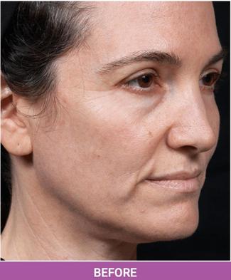 Thermage Before & After Patient #1588